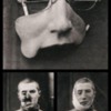 WWI facial prosthesis